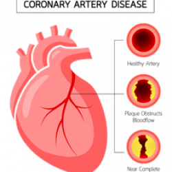 An illustrated diagram showing a heart, with magnified cross-sections of its arteries showing obstructed bloodflow.