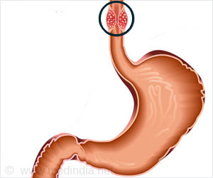 An illustration of an esophagus and stomach. A tumor is shown in the esophagus at the top.
